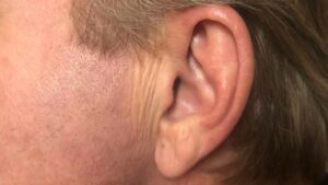Tinnitus – kan man fjerne eller behandle det?